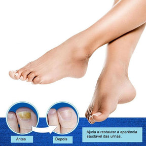 Tratamento de Reparação de Unhas Líquido Removedor de Fungos - Loja Ammix