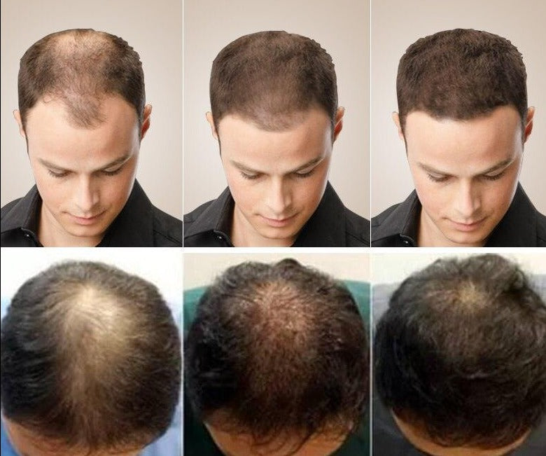 PURC Hair Growth Serum Oils Fast Hair Growth Products Hair &amp; Scalp Treatments for Thinning Beauty Hair Care Men Women 20ml - Loja Ammix